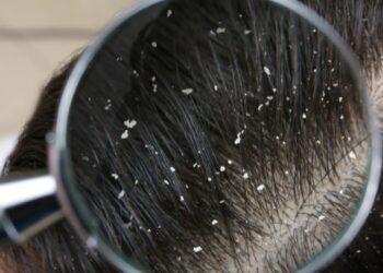 תרופת סבתא לקשקשים